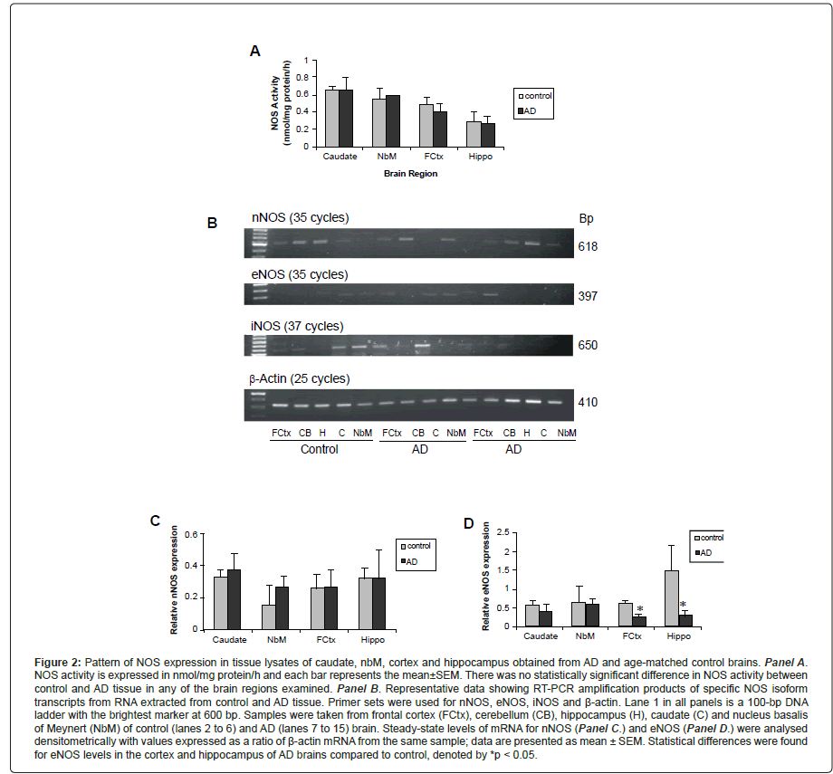alzheimers-disease-parkinsonism-statistically-significant