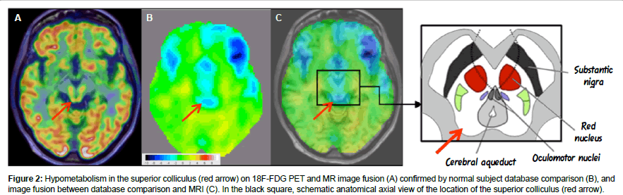 alzheimers-disease-parkinsonism-superior-colliculus