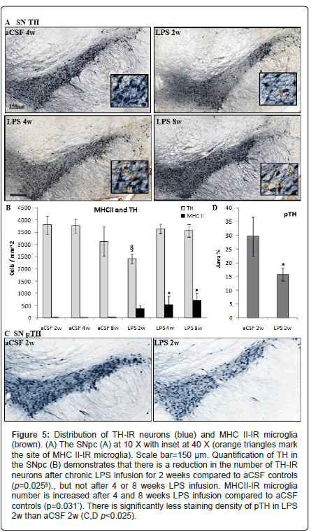 alzheimers-disease-parkinsonism-weeks-compared