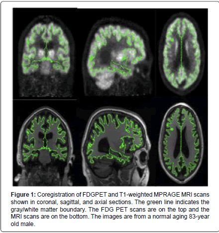 alzheimers-disease-parkinsonism-white-matter