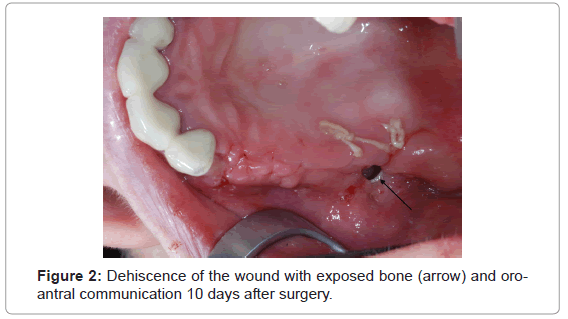 analytical-bioanalytical-techniques-Dehiscence-wound-bone