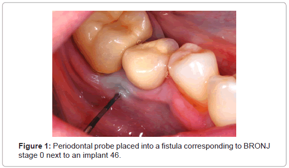 analytical-bioanalytical-techniques-Periodontal-probe-fistula