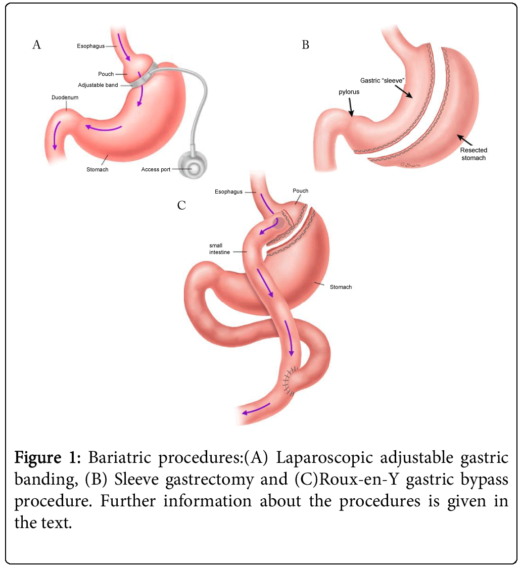 https://www.omicsonline.org/articles-images/anaplastology-Laparoscopic-3-136-g001.png