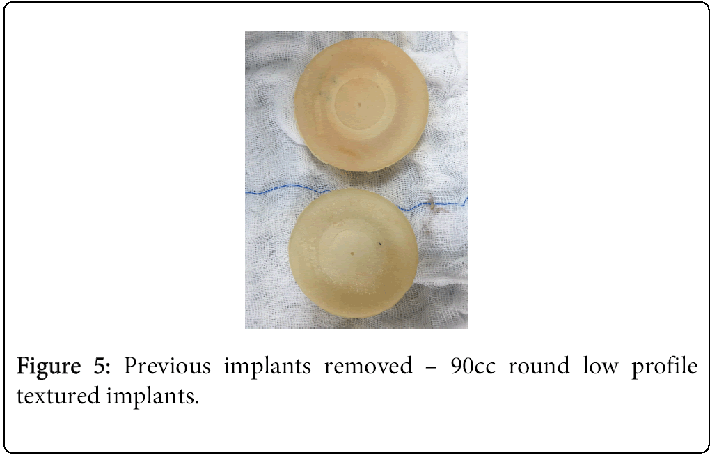 anaplastology-implants-removed