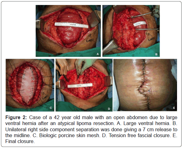 anaplastology-male-abdomen-lipoma