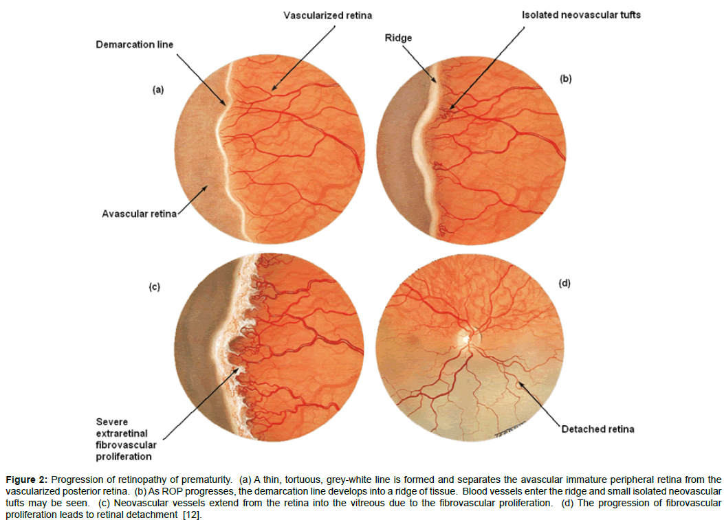 retinopathy of prematurity stage 3