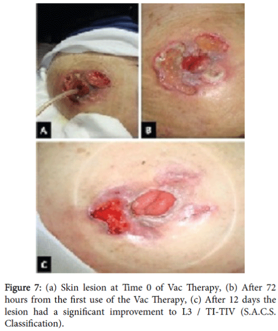 management of peristomal skin complications with negative pressure