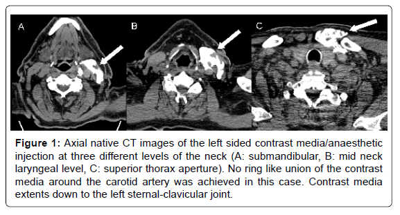 carotid endarterectomy anesthesia