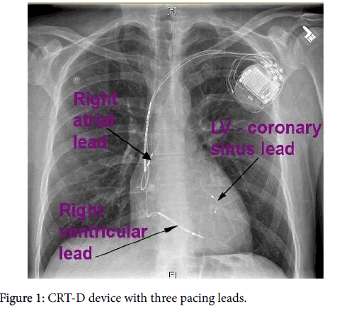 Heart failure essays