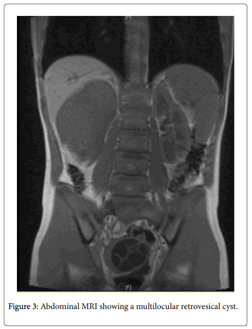 archives-parasitology-retrovesical-cyst