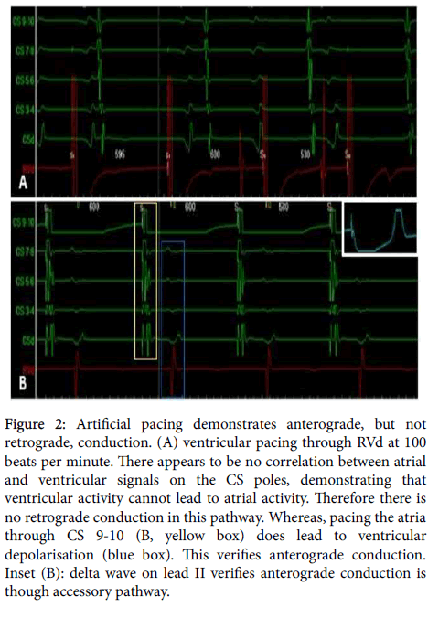 arrhythmia-Artificial-pacing