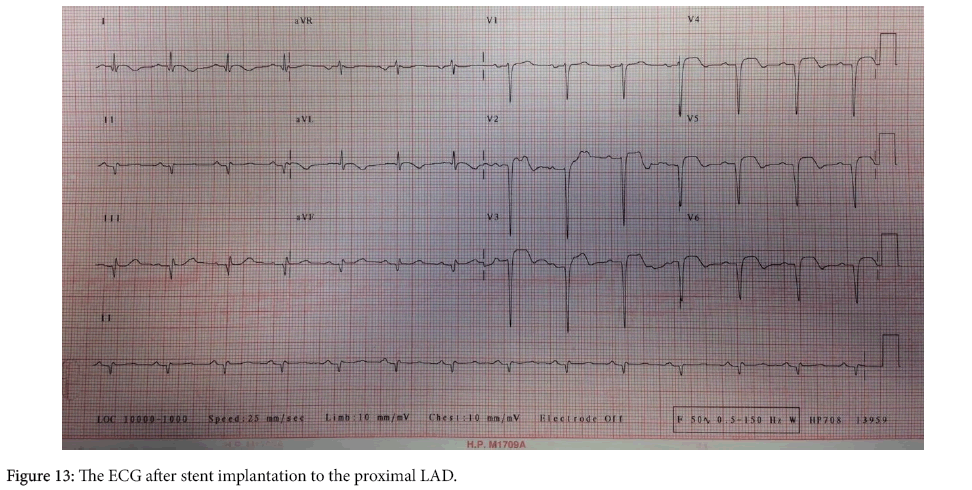 arrhythmia-ECG-after-stent-implantation