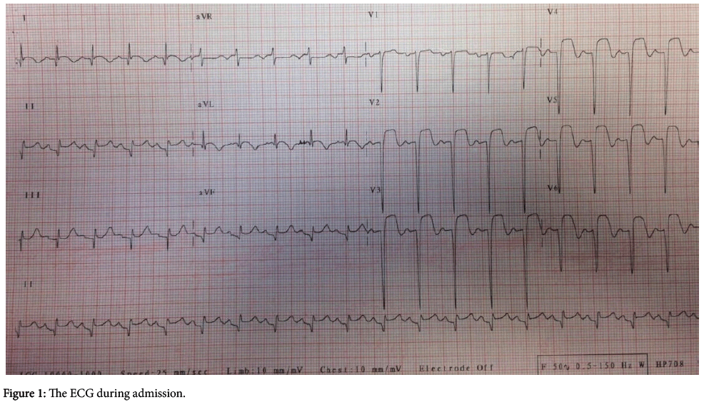 arrhythmia-ECG-during-admission