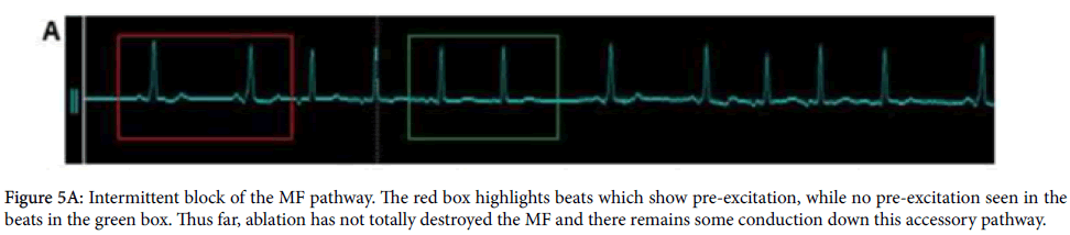 arrhythmia-Intermittent-block