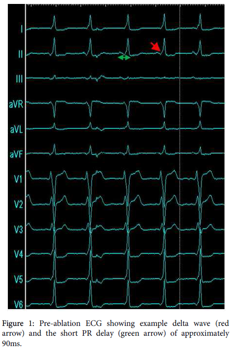 arrhythmia-Pre-ablation-ECG
