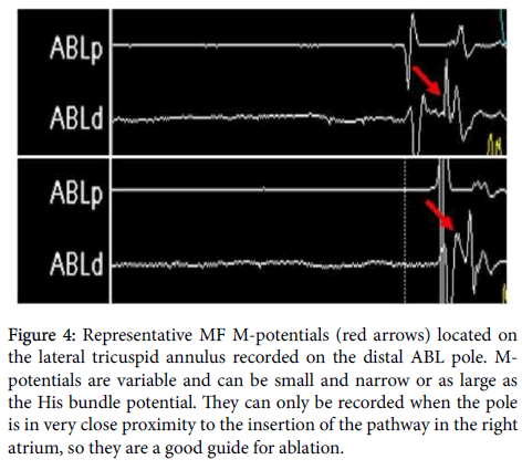 arrhythmia-Representative-MF