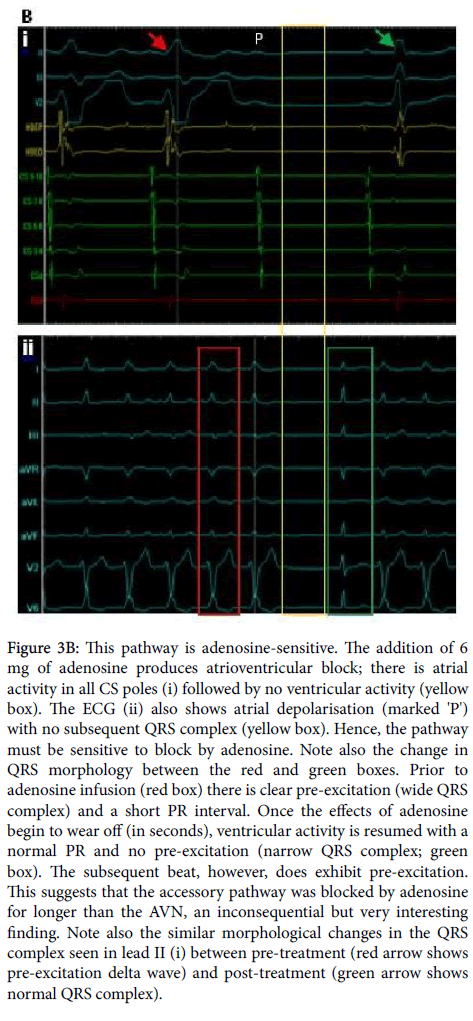 arrhythmia-adenosine-sensitive