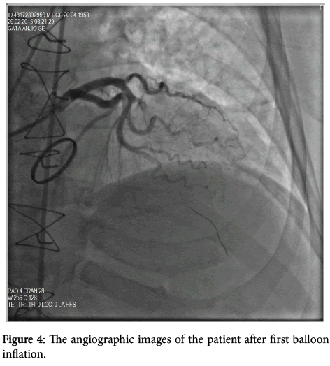 arrhythmia-after-balloon-inflation