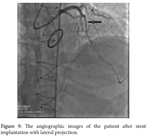 arrhythmia-after-stent-implantation