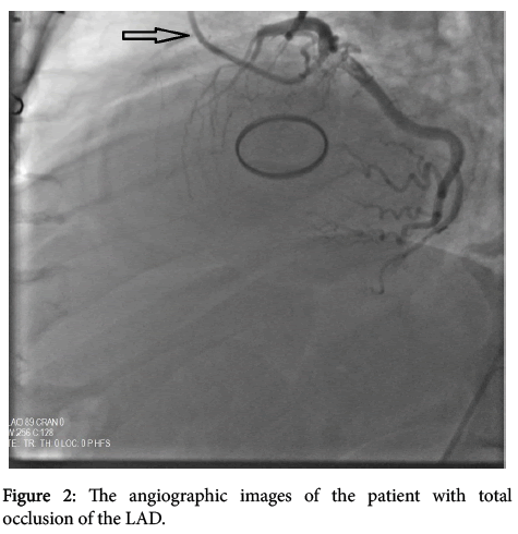 arrhythmia-angiographic-images