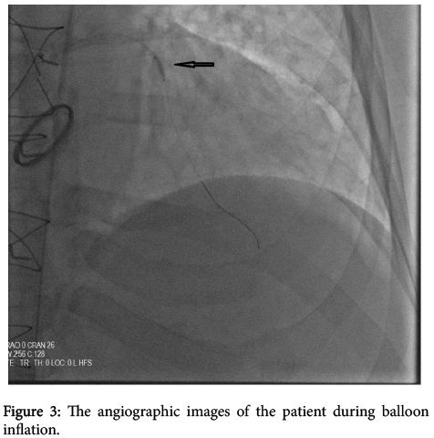 arrhythmia-balloon-inflation