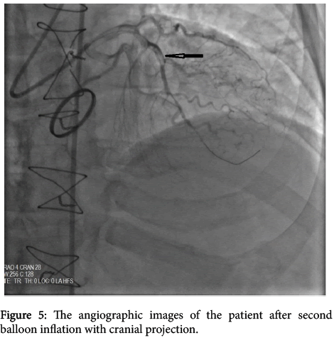 arrhythmia-cranial-projection