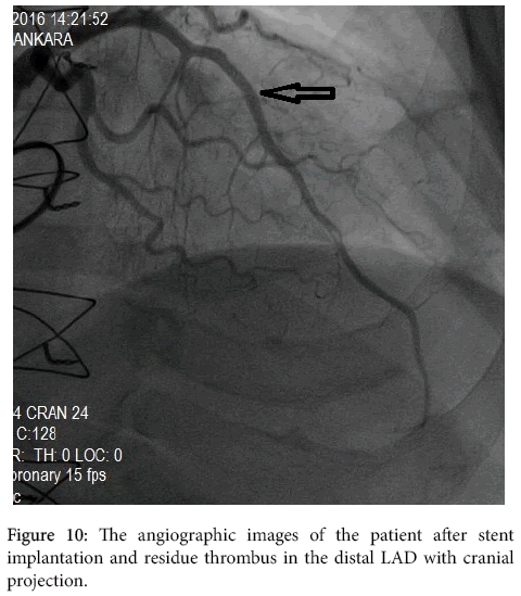 arrhythmia-distal-LAD