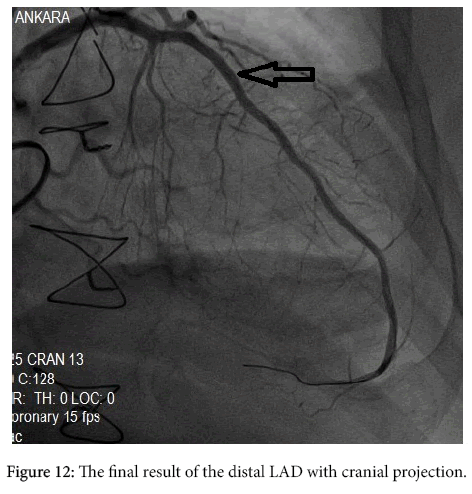 arrhythmia-final-result