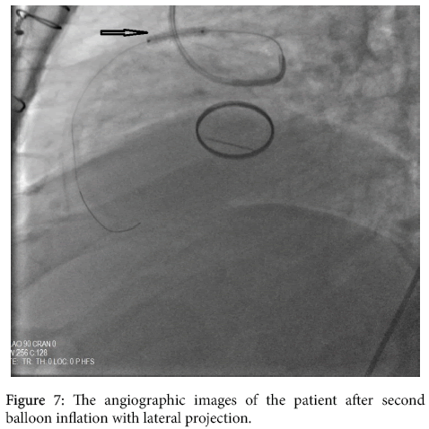 arrhythmia-lateral-projection