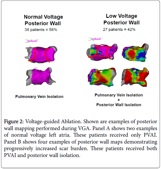 arrhythmia-mapping-performed