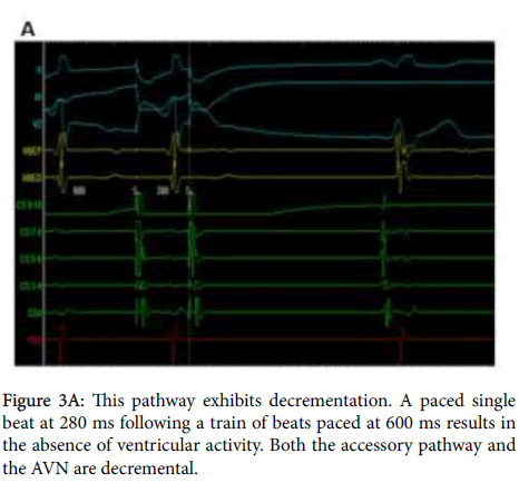 arrhythmia-pathway-exhibits