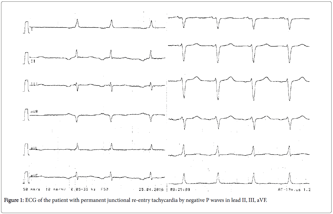 arrhythmia-permanent-junctional