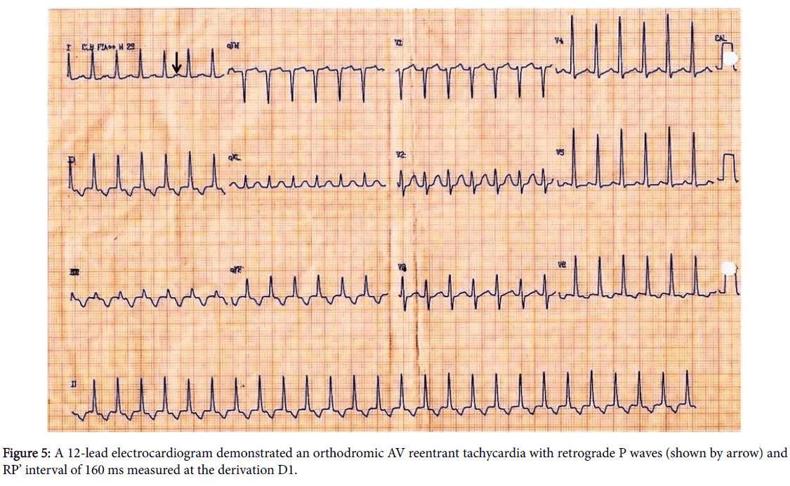 arrhythmia-reentrant-tachycardia