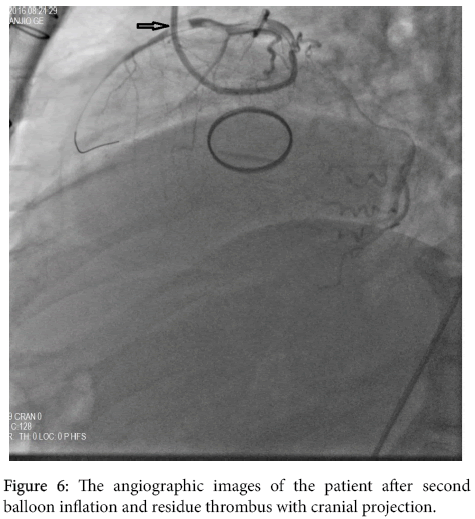 arrhythmia-residue-thrombus