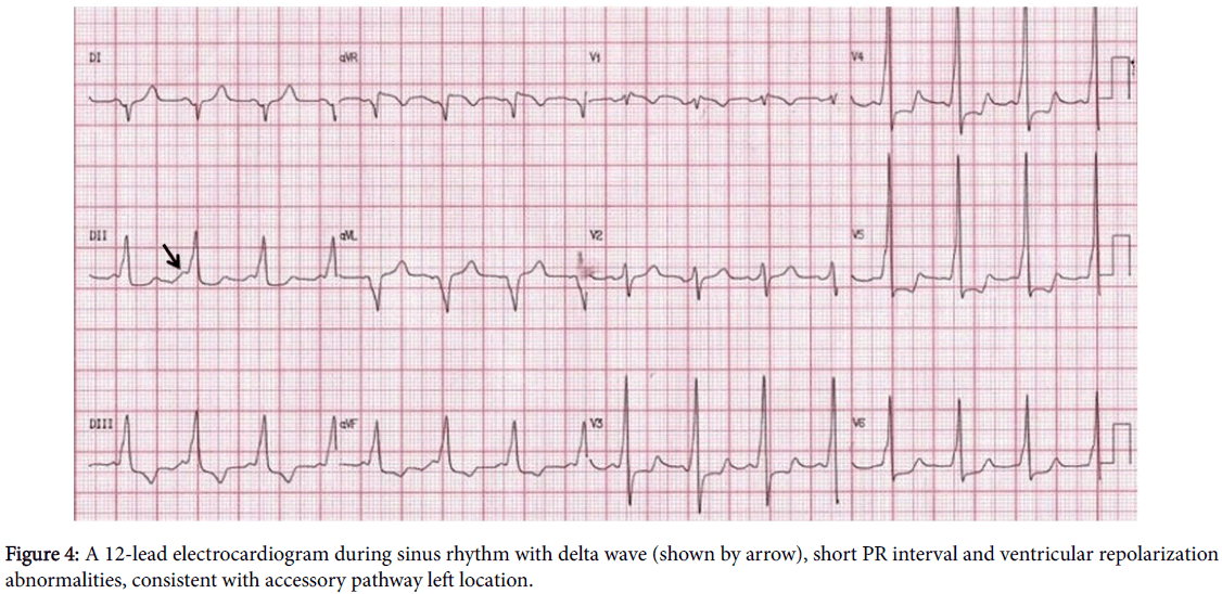 arrhythmia-sinus-rhythm