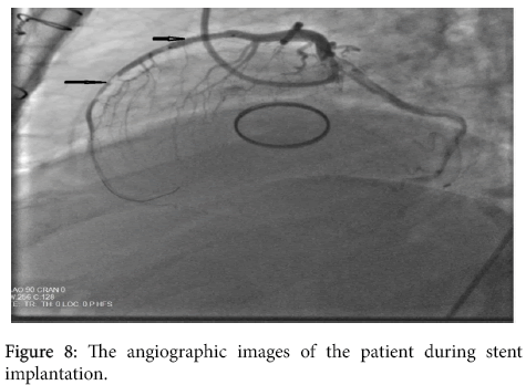 arrhythmia-stent-implantation
