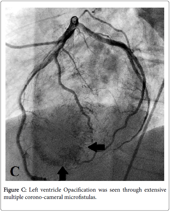 arrhythmia-ventricle-opacification