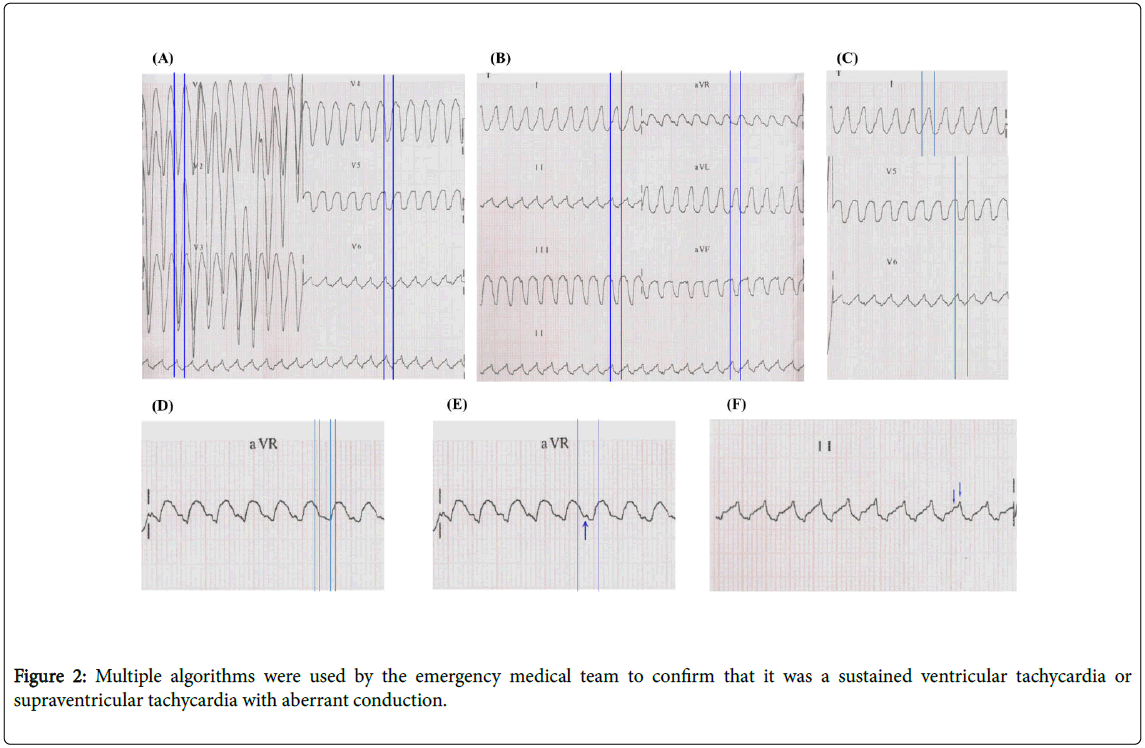 arrhythmia-ventricular-tachycardia