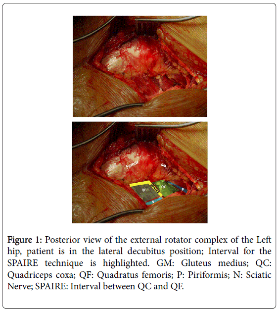 Details of a Tendonand#8211;Sparing Posterior Approach in