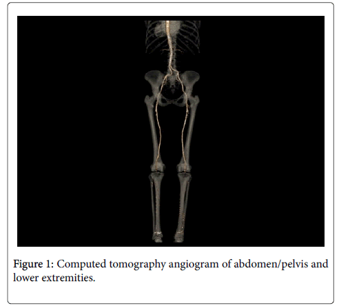 atherosclerosis-Computed-tomography