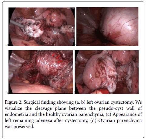 Biology And Medicine Cystectomy Biology And Medicine Cystectomy
