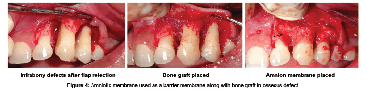 biomimetics-biomaterials-Structure-barrier-membrane