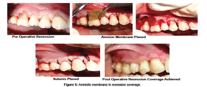 biomimetics-biomaterials-Structure-recession-coverage