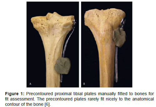 biomimetics-biomaterials-tissue-engineering-Precontoured-proximal-tibial