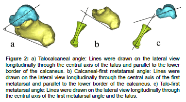 biomimetics-biomaterials-tissue-engineering-Talocalcaneal-angle