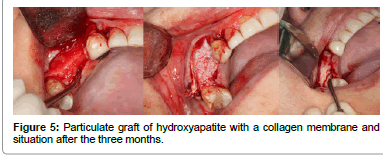 biomimetics-biomaterials-tissue-engineering-hydroxyapatite