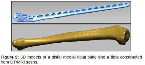 biomimetics-biomaterials-tissue-engineering-medial-tibial-plate