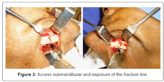 biotechnology-biomaterials-Access-submandibular