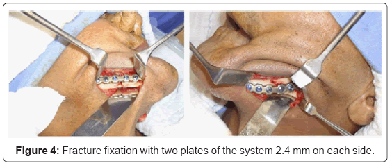biotechnology-biomaterials-Fracture-fixation