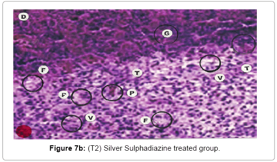 biotechnology-biomaterials-Silver-Sulphadiazine
